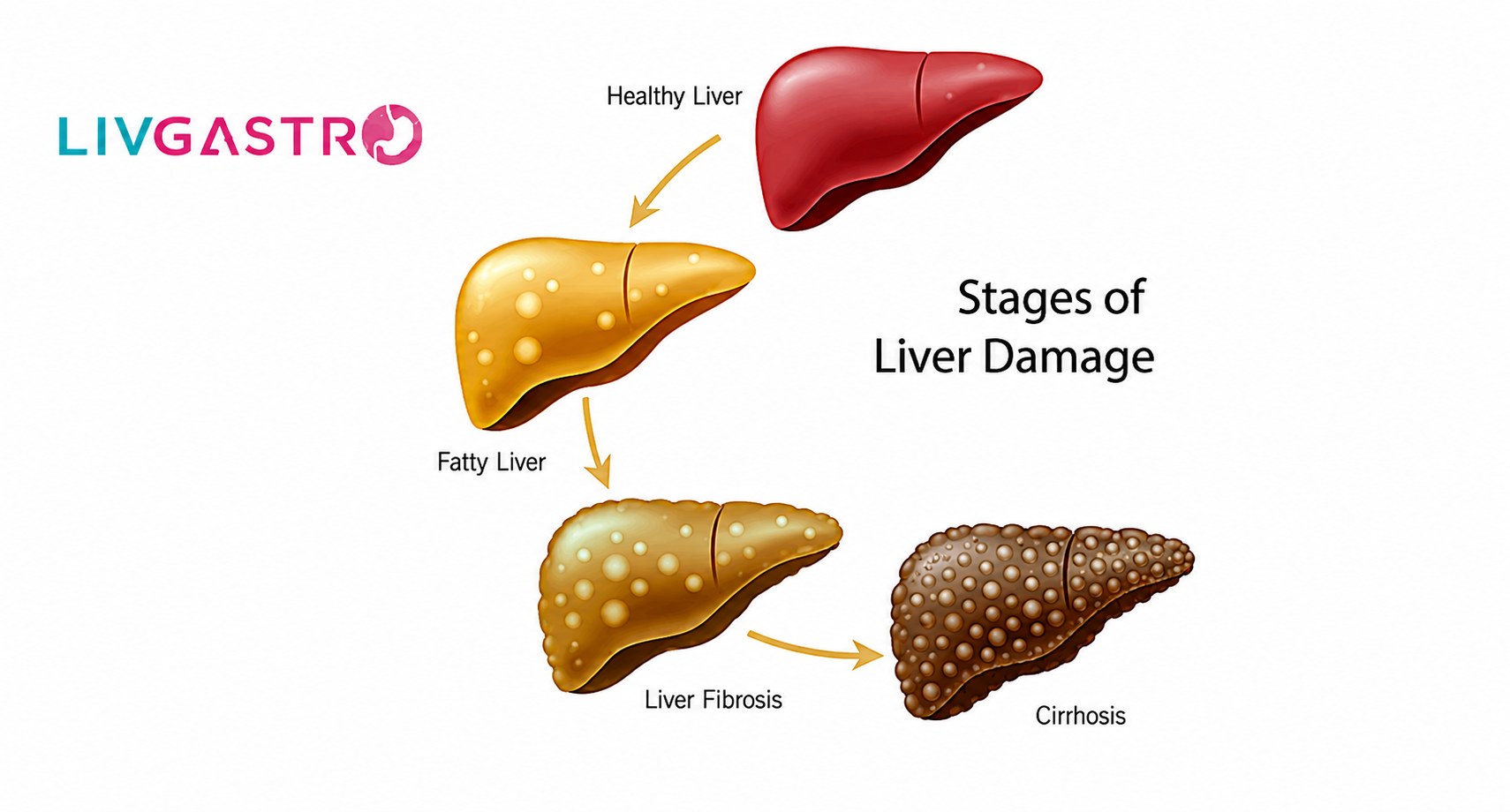 Fatty Liver Disease: Symptoms, Diagnosis & Treatment