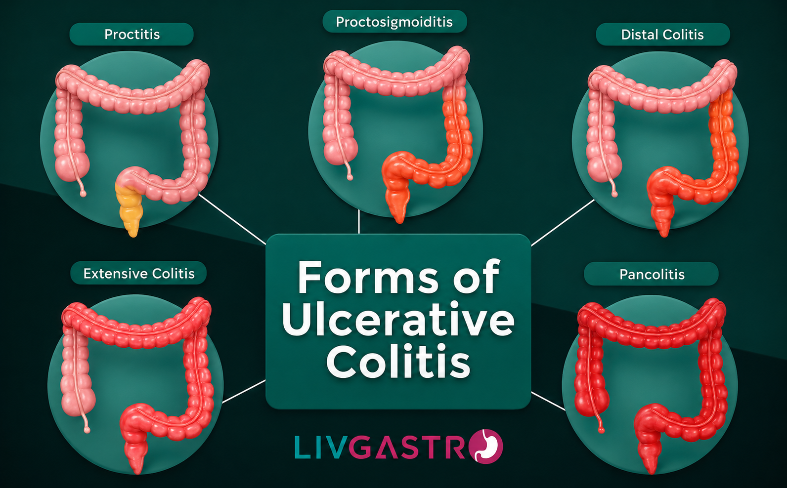 Ultimate Guide to Colitis: Types, Causes, Symptoms & Treatment