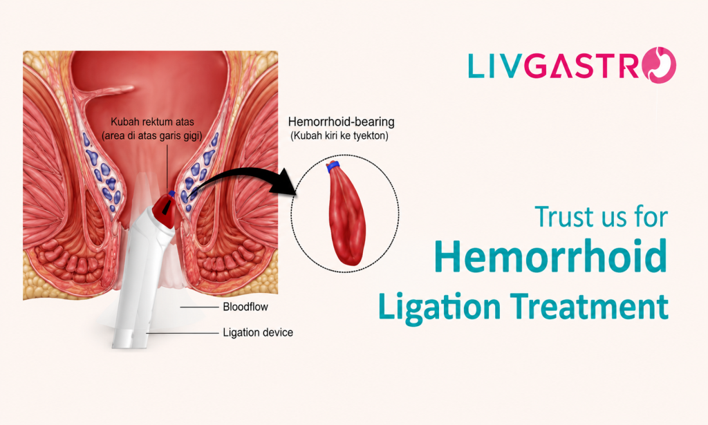 Best Gastroenterology Hospital in Kolkata for Hemorrhoid Ligation Treatment