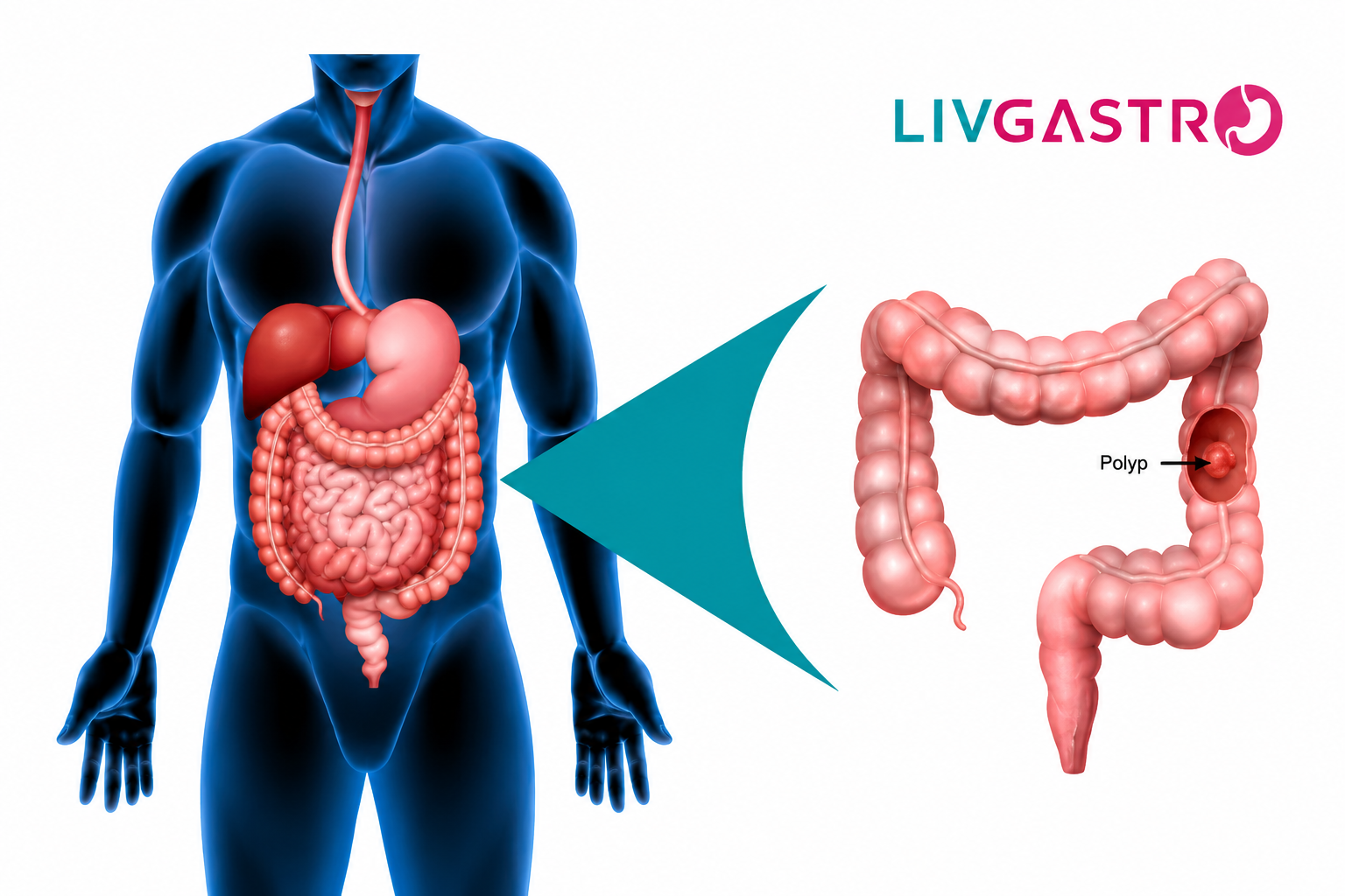 How an Expert Gastro Surgeon Can Help with Polyp Removal