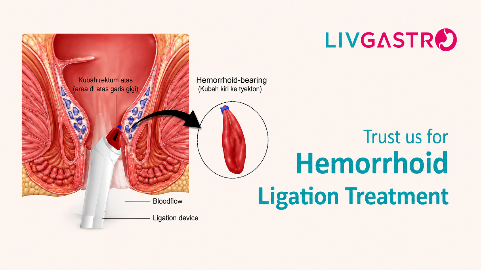Best Hospital for Hemorrhoid Ligation in Kolkata