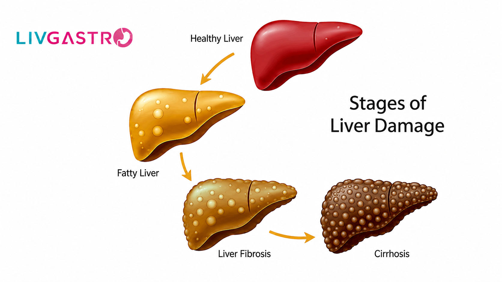 Fatty Liver Disease: Symptoms, Diagnosis & Treatment