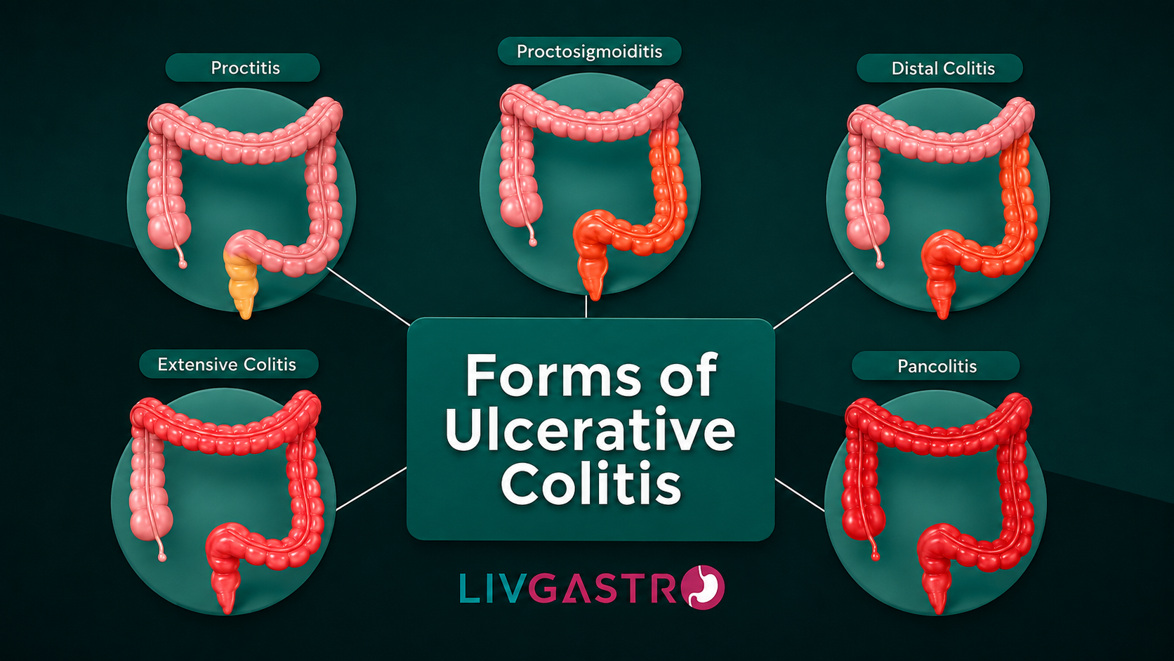 Ultimate Guide to Colitis: Types, Causes, Symptoms & Treatment