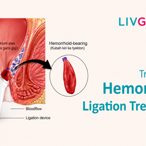 Best Gastroenterology Hospital in Kolkata for Hemorrhoid Ligation Treatment