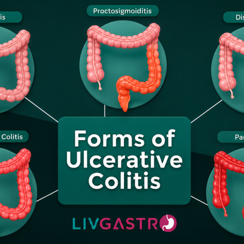 Medical illustration showing inflammation of the colon associated with colitis and its symptoms.