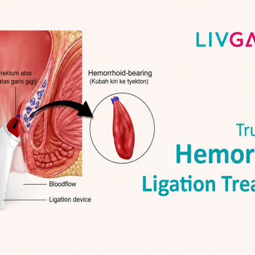 Best Gastroenterology Hospital in Kolkata for Hemorrhoid Ligation Treatment