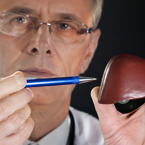 Doctor explaining liver cirrhosis symptoms, causes, and treatment options using a liver health model.