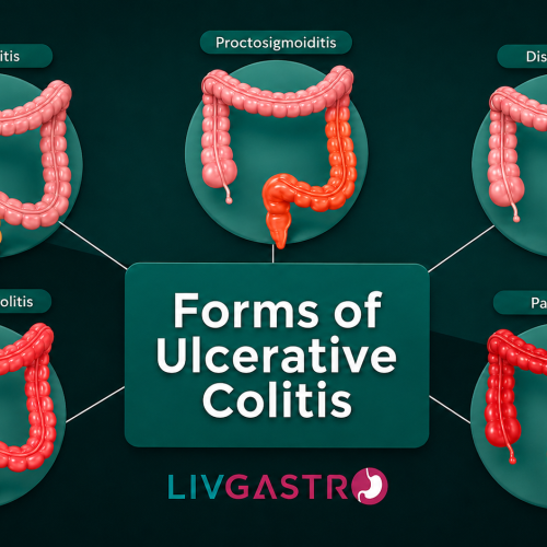 Medical illustration showing inflammation of the colon associated with colitis and its symptoms.